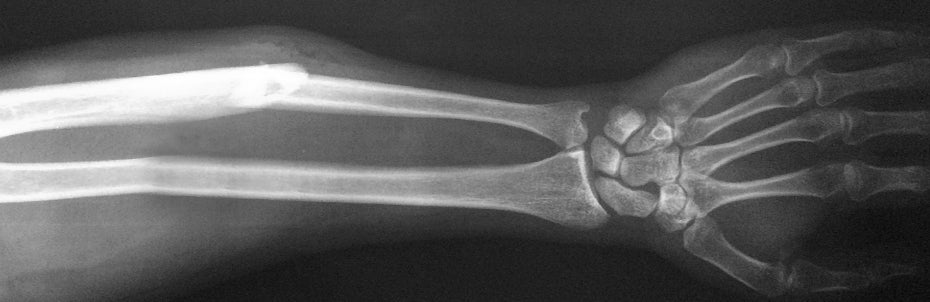 What are the benefits of taking vitamin K2?